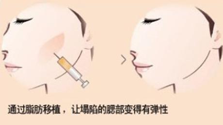 自體脂肪豐蘋(píng)果肌