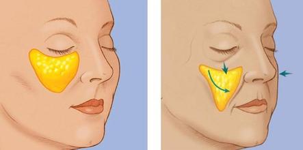自體脂肪豐蘋(píng)果肌