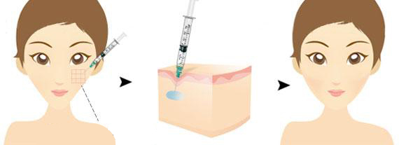 自體脂肪豐蘋(píng)果肌